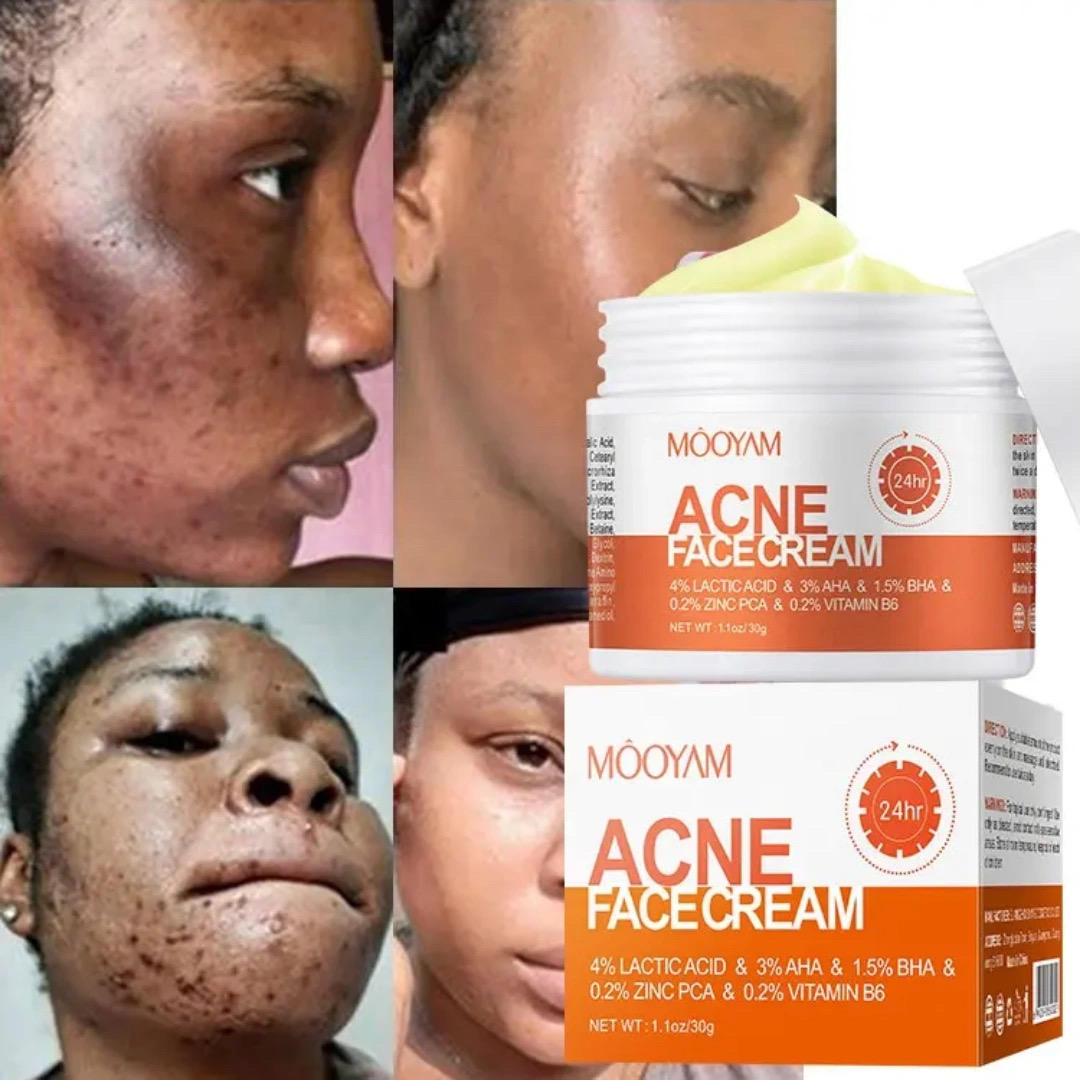 MOOYAM – Crème Visage Anti-Acné & Anti-Imperfections